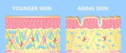 玻尿酸 vs 胶原蛋白，到底谁是注射填充界“一姐”？